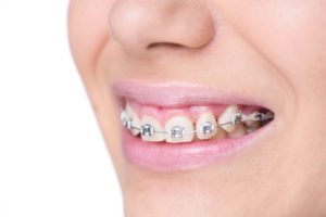 Overbite: Causes, Risks and Treatment — WoodSprings Dentistry