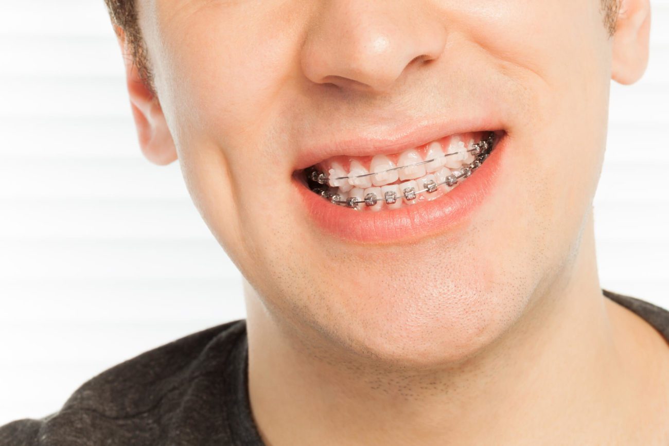 Ceramic Braces  Timonium MD Clear Braces  Adult Braces 