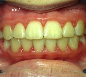 after orthodontics for children in Timonium MD