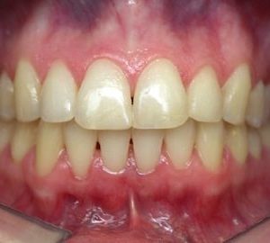 after braces for overbite in Timonium MD