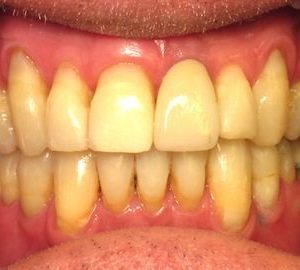 after treating severe crooked teeth in Timonium MD
