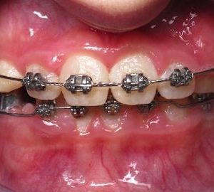 after orthodontics 2 timonium md