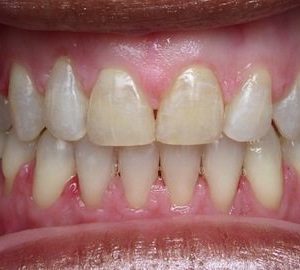 open bite orthodontics in Timonium MD
