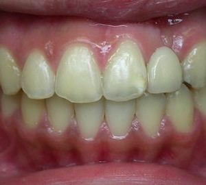 after orthodontics for underbite in Timonium MD