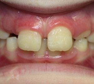 before orthodontics 1 timonium md