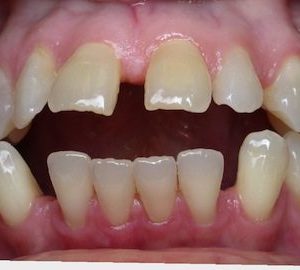 before open bite orthodontics in Timonium MD
