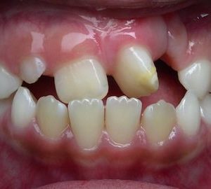 before orthodontics for underbite in Timonium MD