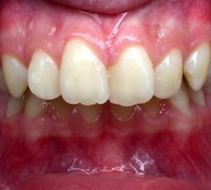 before orthodontics for overbite in Timonium MD