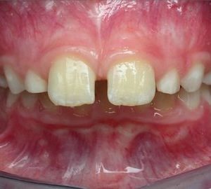before braces for overbite in children in Timonium MD