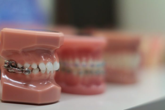 Orthodontic Appliances in Timonium, Maryland