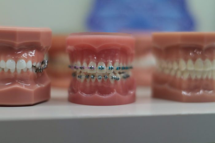 types of braces in Timonium Maryland