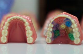 teeth retainers in Timonium MD with orthodontist Mohammad Izadi