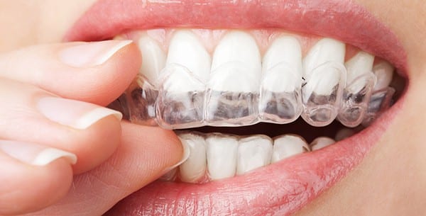 invisalign clear aligners in jacksonville, md