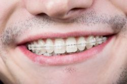 What are Ceramic Braces?  Lutherville, MD Orthodontist