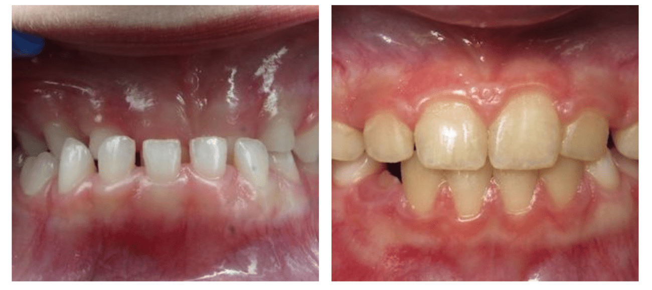 Crossbite treatment Timonium MD