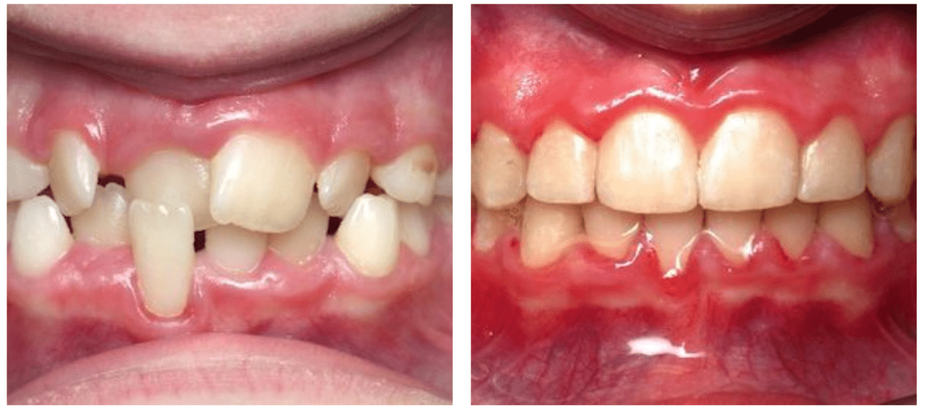 Orthodontic case Timonium MD
