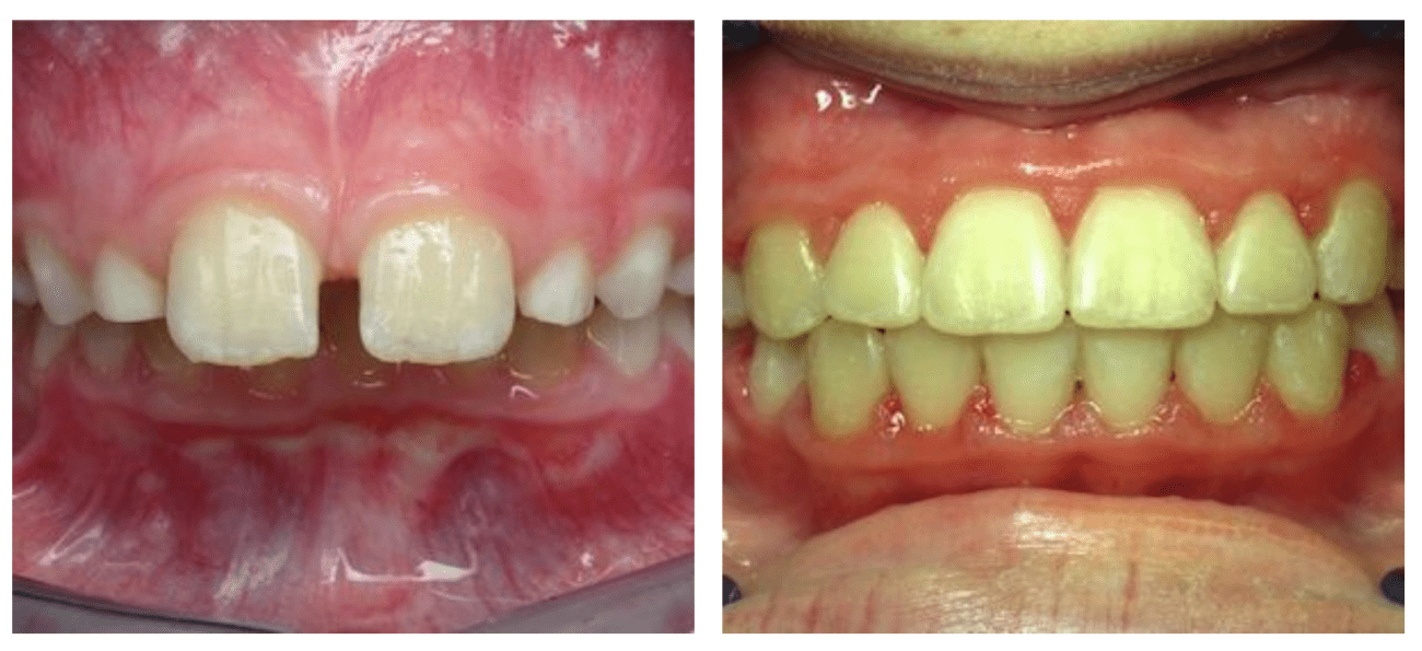 Overbite correction Timonium, MD