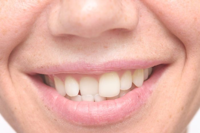 orthodontic relapse in Timonium, MD