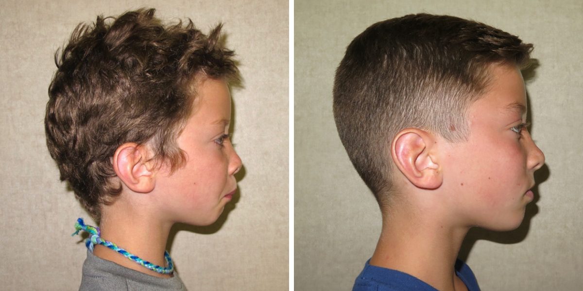 Before and after orthodontics in Timonium