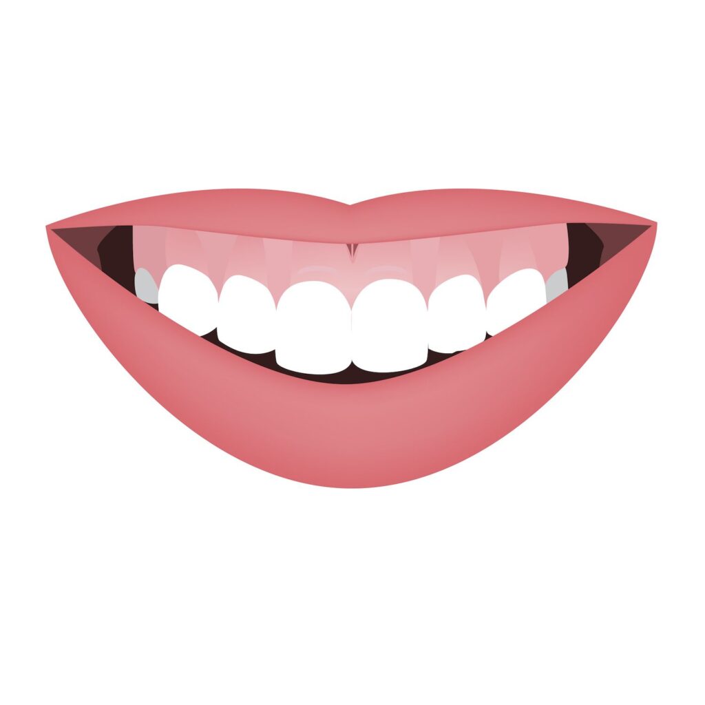 Gummy Smile: Dental or Aesthetic?