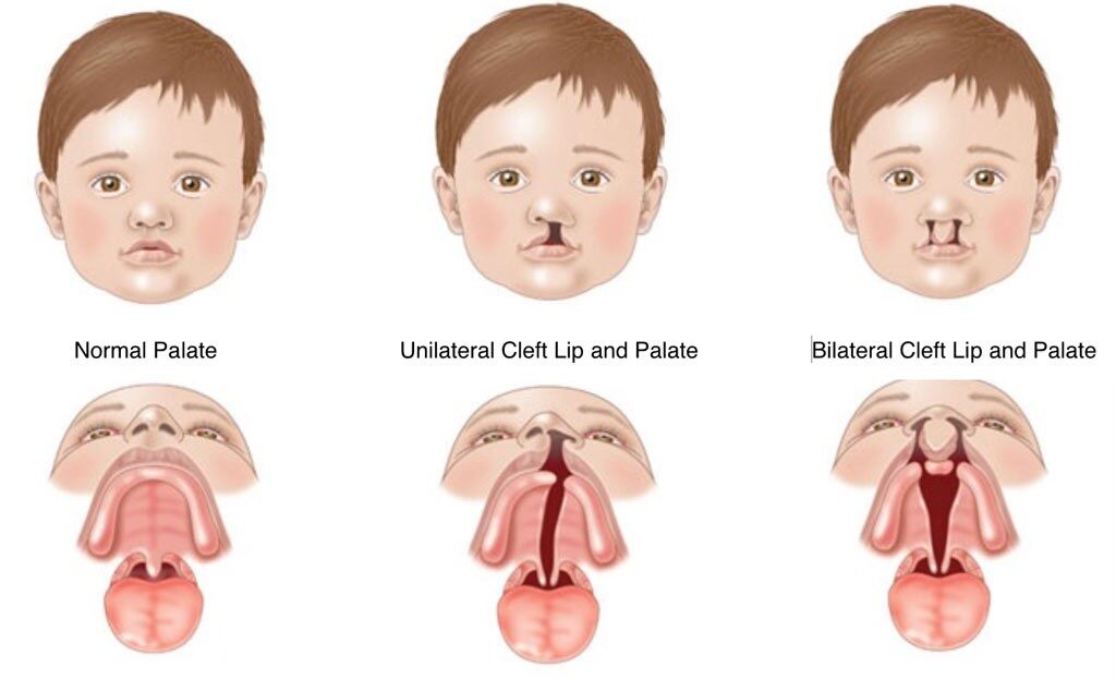 orthodontic treatment for cleft palate in timonium md