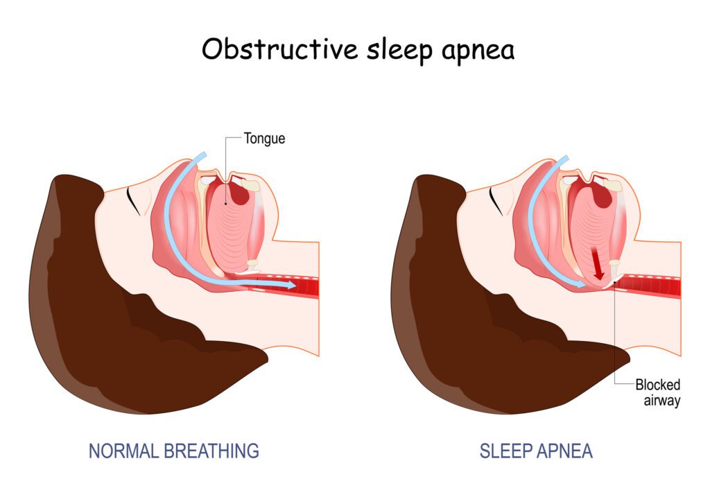 oral appliance therapy for sleep apnea in baltimore md